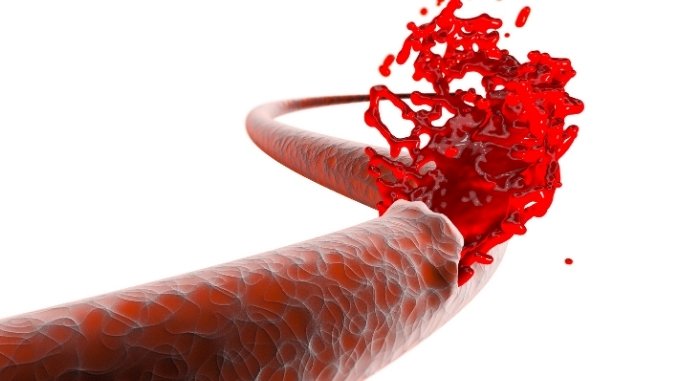 The chances of death from blood loss can be reduced by new diagnostic