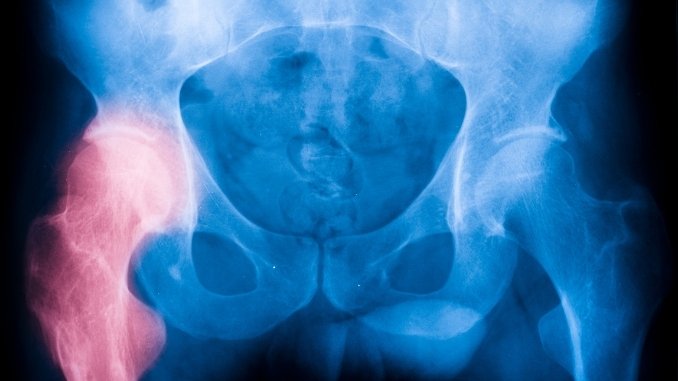 Study In women Obesity increases the risk of early hip fracture Vigorcolumn 1