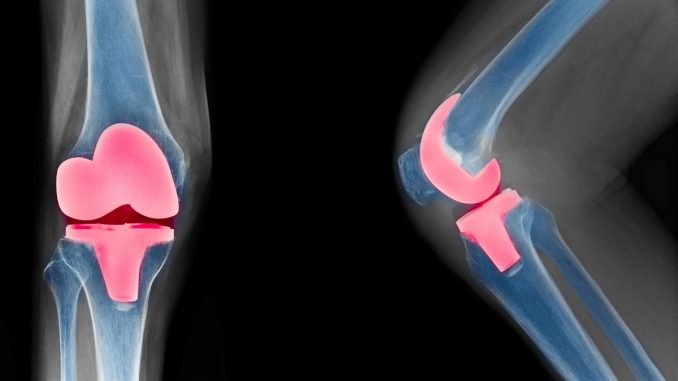 Knee Replacement: Alternate type of surgery may prevent total knee replacement
