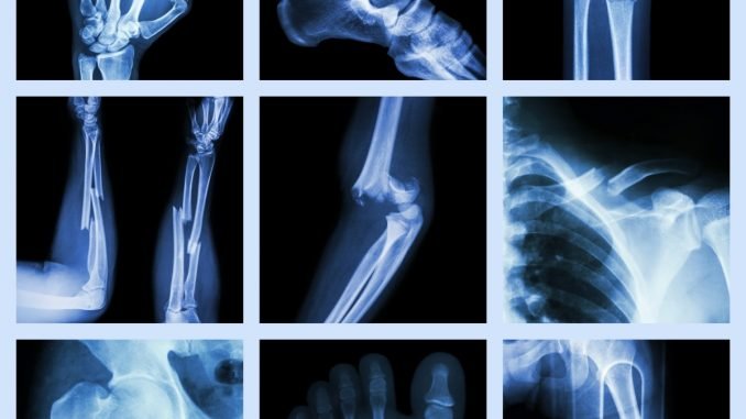 Factors linked with elevated risk of bone fractures